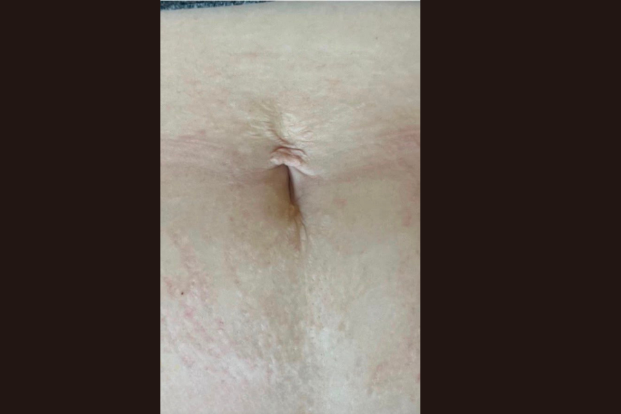 After Inkless Camouflage treatment for belly button scar