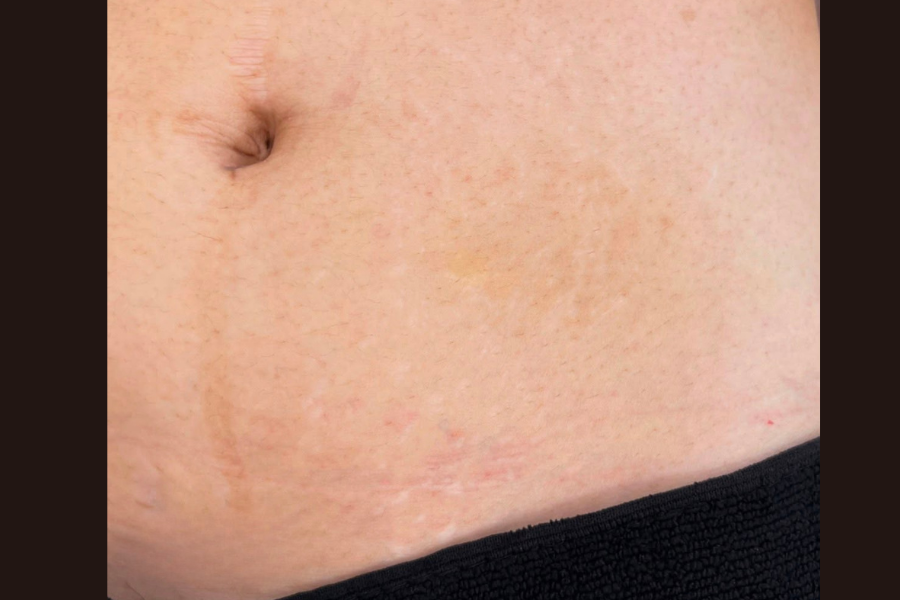 After Inkless Camouflage treatment for abdominal stretch marks