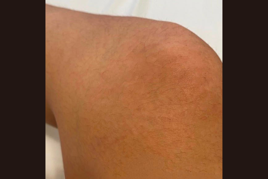 inkless-stretch-mark-camouflage-after-knee