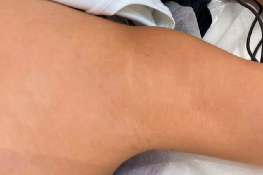 After Inkless Camouflage treatment for upper arm stretch marks