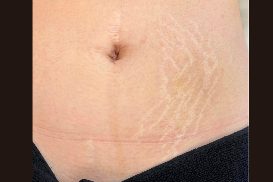 Before Inkless Camouflage treatment for abdominal stretch marks
