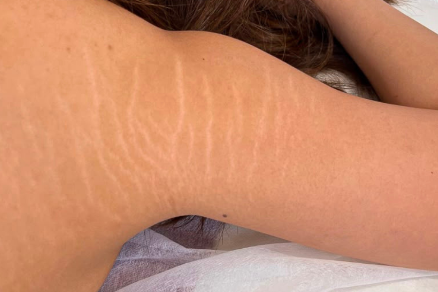 Before Inkless Camouflage treatment for upper arm stretch marks