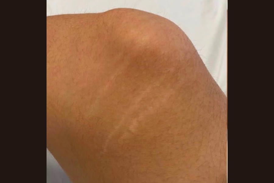 Inkless Camouflage stretch mark treatment