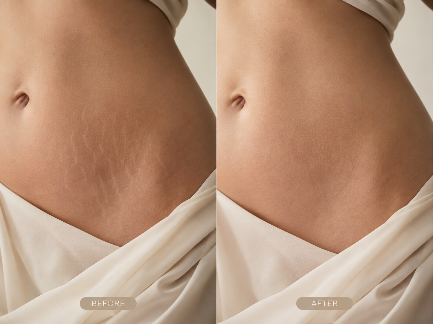 stretch-mark-revision-before-after-abdomen