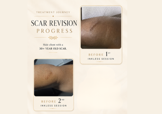 Scar revision progress after Inkless Camouflage sessions