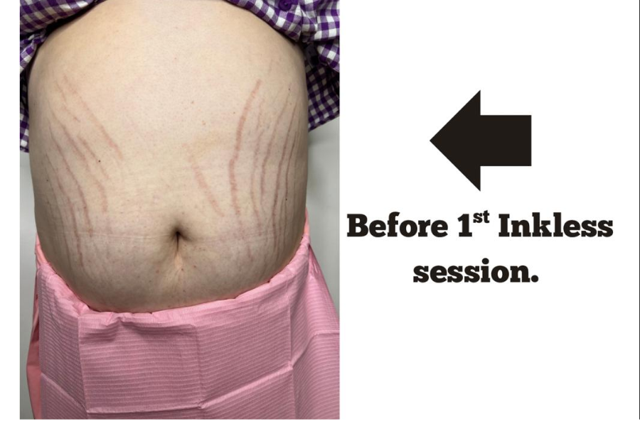 Before Inkless Camouflage treatment at Restoring Beauty Aesthetics