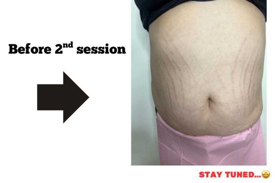 After Inkless Camouflage treatment at Restoring Beauty Aesthetics